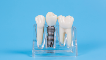 Coeur d'Alene Family Dentistry - Dental Implants in Coeur d'Alene, ID 83814