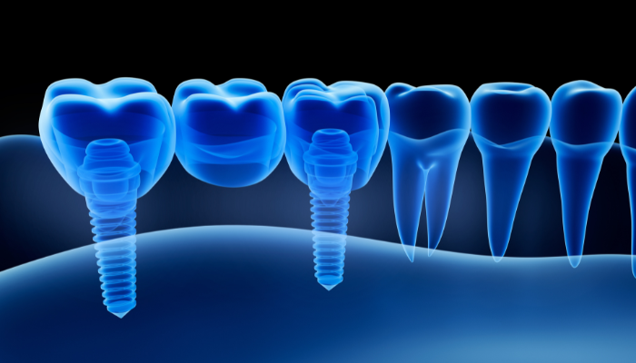 Cox Family Dentistry - Dental Implant Specialist in Allen, TX 75002