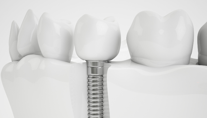 Iroquois Dentistry - Dental Implant Specialist in Nashville, TN 37205