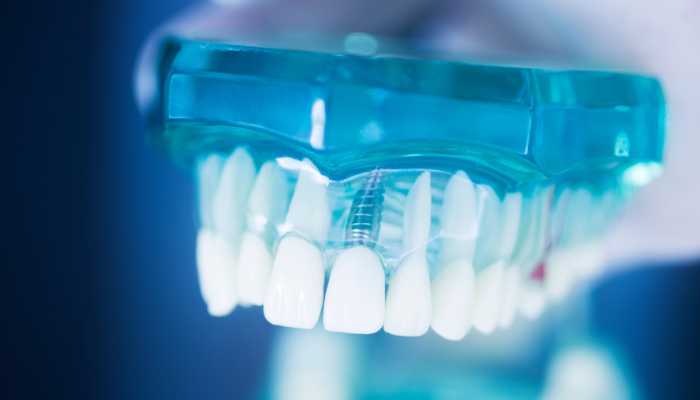 Kayscreek Dental - Dental Implant Specialist in Kaysville, UT 84037