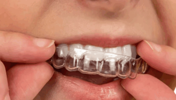 Speaker Orthodontics - Clear Aligners in Lufkin, TX 75904